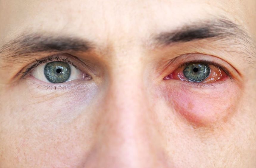 Göz Alerjisi Görme Kaybına Neden Olabilir 2