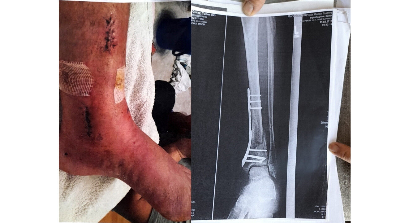 Ayağı Kırılan Gurbetçi