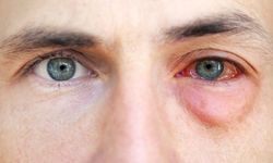 Göz alerjisi görme kaybına neden olabilir