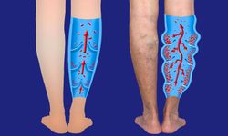 50 yaş üstünde venöz hastalık riski yüksek!