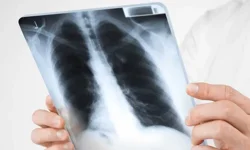 Antalya İl Sağlık Müdürlüğü’nden uyarı “Tüberküloza dikkat”