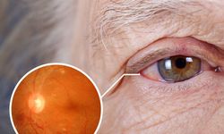 Göz sağlığında gizli tehlike: Glokom