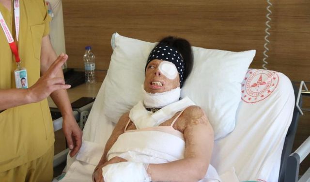 Türkiye'de ikinci Bergen vakası! Yasemin Uzunçelebi'nin kezzapla yanık kabusu ve umut dolu mücadelesi...
