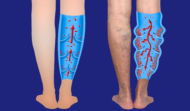 50 yaş üstünde venöz hastalık riski yüksek!