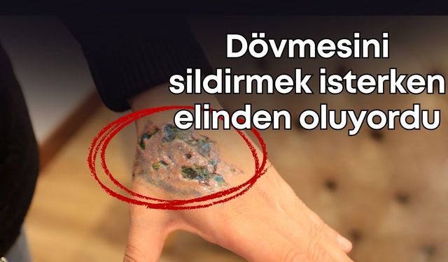 Dövmesini sildirmek isterken elinden oluyordu