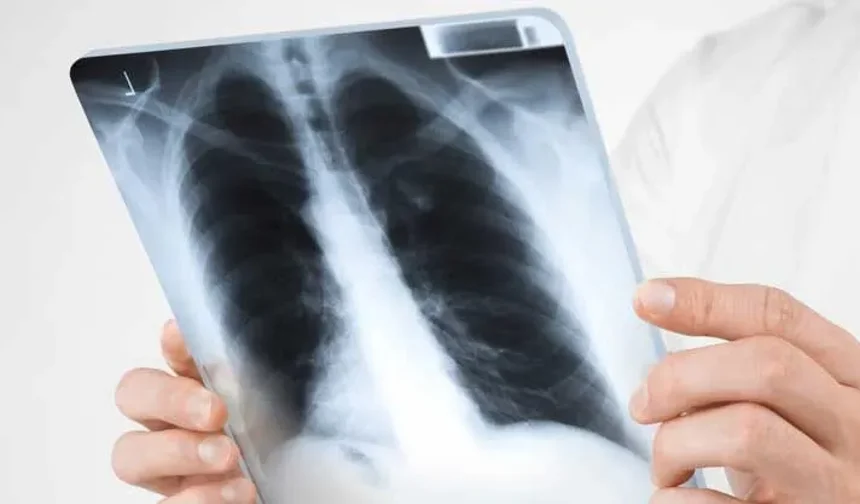 Antalya İl Sağlık Müdürlüğü’nden uyarı “Tüberküloza dikkat”